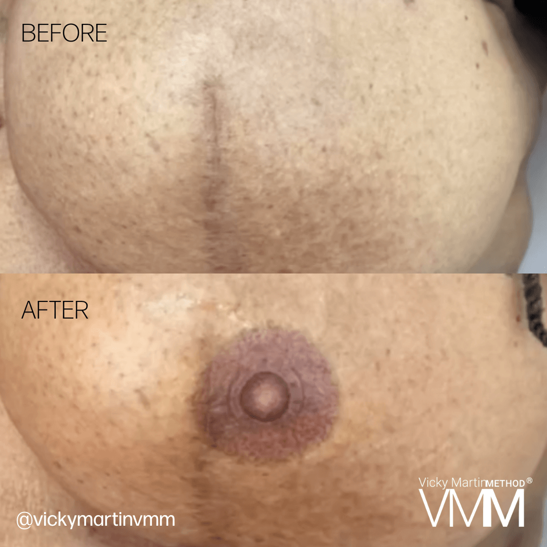 Before and After Vicky Martin Method Areola Reconstruction on breast cancer survivor